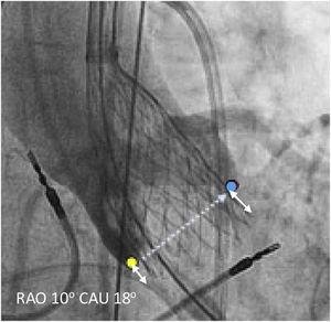 Depth assessment measured from the noncoronary cusp (yellow dot) and the left coronary cusp (blue dot), respectively, to the deepest intraventricular portion of the valve.