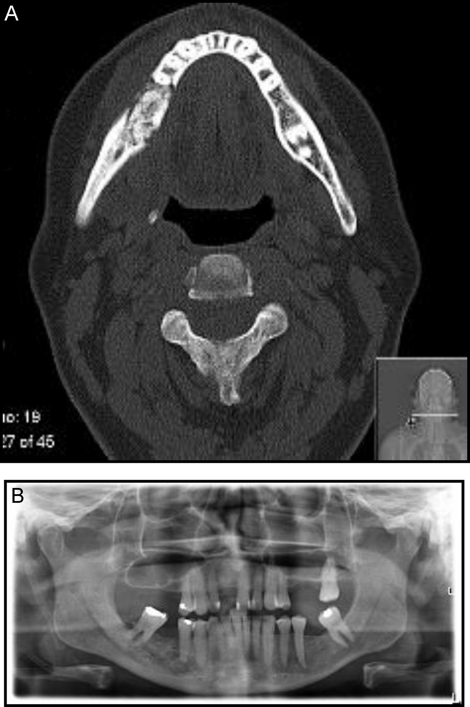 TC DE MANDIBULA • AMD Saúde