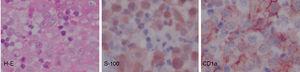Histiocitosis de células de Langerhans, con marcadores inmunohistoquímicos CD1a y S100 intensamente positivos (100x).