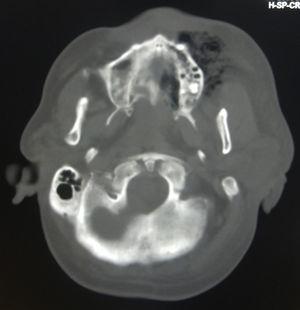 TAC inicial donde se observan zonas hipodensas relacionadas a proceso infeccioso que compromete el hueso maxilar izquierdo.