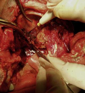 Imagen transquirúrgica donde se observa el proceso infeccioso hacia la lámina cribiforme.