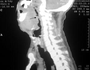 Corte sagital de una tomografía computarizada donde se observa una disminución de la luz de las vías aéreas de la región cervical.