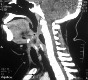 Corte sagital de tomografía computarizada donde se observa una disminución de la luz de las vías aéreas (flecha superior) con un acúmulo de colección en la región retroesternal (flecha inferior).