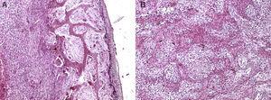 Histopatología (HE). A y B) Límite de lesión en donde se observa tejido osteoide trabecular del estroma fibroblástico con presencia de algunas células gigantes multinicleadas.