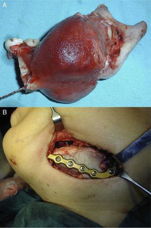 A) Pieza quirúrgica resecada en la que puede observarse la tumoración de la superficie lisa. B) Abordaje submandibular. Injerto costocondral y de la cresta ilíaca en posición.
