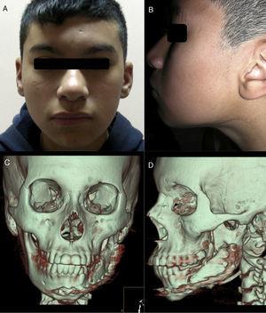Control clínico (A y B) y radiográfico de 7 años posterior a la intervención (C y D). Se observa una simetría facial adecuada, una cicatriz casi imperceptible y la remodelación total del injerto.