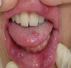 The oral ulcers in the edge and back of the tongue and lips.