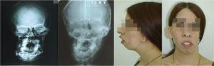 Imágenes radiográficas que revelan la historia quirúrgica, A1 con distractores, A2 con los tornillos de fijación en cirugía sagital de rama. B1 y B2: frente y perfil actual de la paciente.