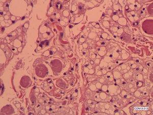 Hibernoma de cavidad oral. Aposición de células multivacuoladas y miocitos estriados, rojizos. Las células adiposas muestran núcleos centrales en las células microvacuoladas y excéntricos en aquellas en las que las macrovacuolas lo desplazan a la periferia (HE ×200).