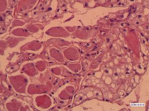 Hibernoma de cavidad oral. Aposición de células del hibernoma con miocitos estrellados. Detalle (HE ×200).