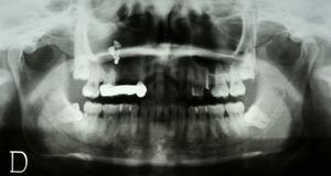 Imagen de la ortopantomografía del caso 1, en la que se observan imágenes con radioopacidad metálica a nivel de seno maxilar derecho.