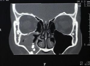 Imagen de TC coronal sinusal del caso 1, en la que se observan varias imágenes radioopacas de densidad metálica a nivel de seno maxilar derecho, acompañadas de inflamación de toda la mucosa sinusal derecha.