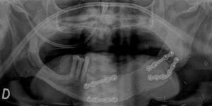 Caso 1. Ortopantomografía realizada 3 meses tras la reconstrucción con un colgajo pediculado osteofascial parietal bicortical, donde se demuestra la buena osteointegración y viabilidad del mismo.