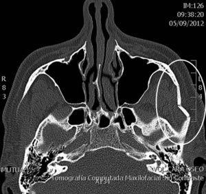 TAC sin contraste prequirúrgico. Corte axial. FAAC en forma de «M» del lado izquierdo.