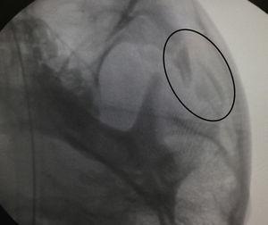Imagen intraoperatoria obtenida con el arco en C. Se observa una reducción insuficiente en el arco izquierdo. La tecnología permite al cirujano reaccionar inmediatamente dentro del quirófano.