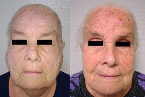 Paciente con masa parotídea bilateral, antes y después del tratamiento con corticoides, vista frontal.