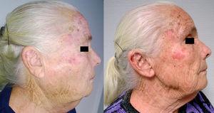 Paciente con masa parotídea bilateral, antes y después del tratamiento con corticoides, vista lateral.