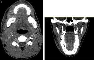 Imagen radiológica de TC cérvico-facial donde se observa ulceración y engrosamiento asimétrico de la mucosa yugal del cuarto cuadrante con trabeculación de la grasa adyacente. Cortes axiales (a) y coronales (b).