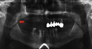 Ortopantomografía. Imagen radiolúcida irregular en rama ascendente mandibular derecha.