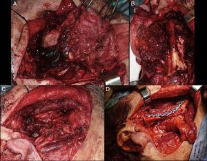 A) Parotidectomía radical incluyendo tronco y ramas del VII par craneal. B) Hemimandibulectomía derecha. C) Defecto quirúrgico posresección. D) Reconstrucción con colgajo microvascularizado de peroné.