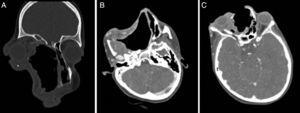 (A) (Coronal), (B) and (C) (Axial) sections of contrast enhanced CT scan done post operatively.