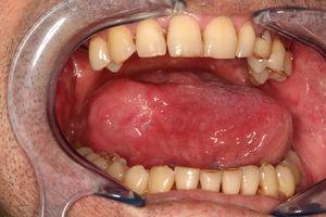 Clinical photograph showing the mass within the right side of the tongue.