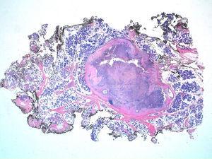En la imagen se observa una tumoración predominantemente sólida con áreas quísticas. La tumoración se halla bien delimitada, con una seudocápsula fibrosa que la separa del parénquima de glándula salival. Hematoxilina-eosina (lupa).