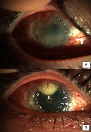 Early postoperative findings after tectonic penetrating keratoplasty in the left eye. Corneal transplant is edematous and shows fibrotic changes. Note the superior neovascularization secondary to graft failure. Early postoperative findings in the right eye after the first penetrating keratoplasty. Severe conjunctival infection with a dense superior infiltrate in the interface suggestive of infection. The transplant appears edematous and with Descemet folds in the visual axis.