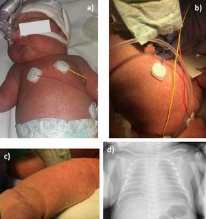 Congenital cutaneous candidiasis: maculopapular skin rash at birth affecting the face (a), trunk (b) and limbs (with peeling) (c); chest X-ray showing bilateral interstitial lung infiltrates (d).