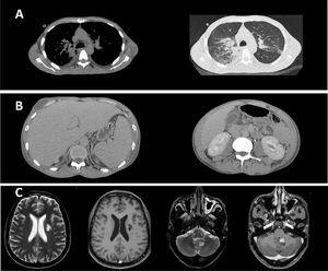 Paracoccidioidomycosis diagnostic by computed tomography (CT) and magnetic resonance imaging (MRI). (A) Chest CT showing: (1) moderate bilateral pleural effusion; (2) bilateral pleural effusion and ground-glass opacities predominating in posterior fields of both lungs, sometimes confluent (consolidations). (B) Abdominal CT showing mesenteric lymphadenopathy with necrotic center, sometimes clustered. (C) Brain MRI showing an area of signal change in corona radiate, characterized by hypersignal in T2-FLAIR and hyposignal in T1, without contrast enhancement. In addition, an intra-axial lesion, partially calcified and with pathological enhancement by venous contrast, was observed near the left lateral wall of the fourth ventricle, without mass effect or peripheral edema.