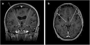 Example MRI showing the trajectories of the implanted electrodes in the coronal (a) and axial (b) planes. The electrode artefacts visible in the post-operative CT scan were used to determine the entry point and the distal tip.