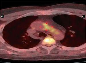 Combinación de imágenes de tomografía de emisión de positrones (PET) y TC de fila multidetector en un paciente con diabetes del ensayo FREEDOM.