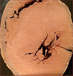 Miocardiopatía hipertrófica. Gentileza del Dr. Juan Carlos Borondo (Instituto Nacional de Toxicología y Ciencias Forenses)