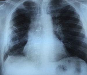 Radiografía PA de tórax que muestra rotura de grapas de nitinol.