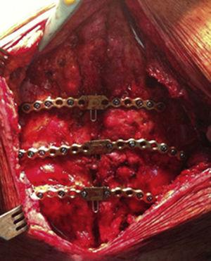 Imagen intraoperatoria que muestra resultado tras implantación de sistema de fijación esternal mediante placas y tornillos de titanio.