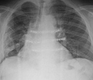 Radiografía PA de tórax que muestra fijación esternal mediante placas y tornillos de titanio.