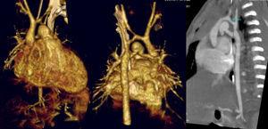 Coartación y arco aórtico hipoplásico en neonato de 25 días de vida y 2,8kg, con hipoplasia severa de arco distal (2,3mm de diámetro). TC multicorte. De izquierda a derecha: reconstrucción tridimensional con vista anterior y posterior, a la derecha corte sagital. Cortesía de la Dra. M. Bret.