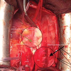 Campo quirúrgico que muestra el drenaje venoso anómalo parcial (flecha negra) y la comunicación interauricular tipo seno venoso (flecha verde).