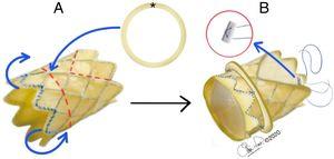 A. Válvula Melody®. Las líneas curvas azules indican el pliegue externo del extremo proximal del stent. La línea roja discontinua circular indica el sitio de fijación del anillo de pericardio bovino (☆). Las líneas rojas discontinuas rectas indican el sitio de recorte distal del stent. B. Vista final de la válvula con el anillo de pericardio fijado, extremo proximal del stent plegado y extremo distal del stent recortado. Dentro del círculo rojo, punto de PTFE apoyado en teflón.