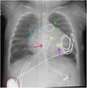 Radiografía toracoabdominal donde se observan: anillo de la válvula mecánica mitral (flecha roja), anillo del conducto VD-AP (flecha verde), electrodo epicárdico de fijación activa (flecha violeta), electrodos epicárdicos de contacto en aurícula derecha (puntos azules), electrodos epicárdicos de contacto en VD (puntos amarillos) y generador de marcapasos tricameral en bolsillo paralumbar derecho retromuscular (semicírculo rojo).