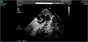 Caso clínico 1. Imagen ecocardiográfica de la ventana aortopulmonar con unas dimensiones de unos 10mm (entre cruces de demarcación).
