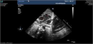 Caso clínico 2. Imagen ecocardiográfica correspondiente a la ventana aortopulmonar amplia. Ao: aorta ascendente; Pu: arteria pulmonar; V: ventana aorto-pulmonar.