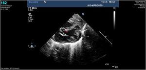 Caso clínico 2. Imagen ecocardiográfica correspondiente al TSVI nativo previo a la cirugía de cierre de VAP donde no se aprecian datos ecocardiográficos de obstrucción del TSVI. V Ao: válvula aórtica.