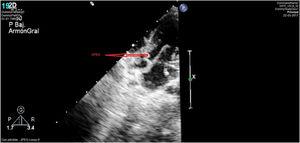 Caso clínico 2. Imagen de ecocardiografía a los 30 meses que muestra una obstrucción severa en el TSVI. OTSVI: obstrucción TSVI.