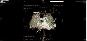Imagen procesada de la cardio-RMN preoperatoria mostrando el rodete fibromuscular (flechas) inmediatamente por debajo del anillo pulmonar nativo preservado.