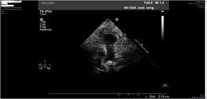 Último control ecocardiográfico postoperatorio (cinco meses) donde se mide un anillo pulmonar nativo normalizado de 21,4 mm (z-score = + 0,02), con un tronco y ramas pulmonares de buen calibre.