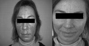 Obtenidas de una paciente con rosácea. A la izquierda se aprecia el aspecto previo al tratamiento. Se puede ver la mejoría de las telangiectasias y el eritema.