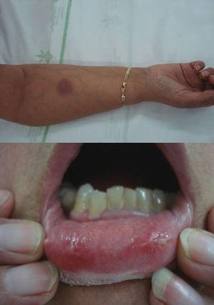 Placas en mucosa oral y placa cutánea ovalada eritemato-violácea y edematosa en antebrazo características de eritema fijo medicamentoso mucocutáneo tras la toma de sulfamidas.