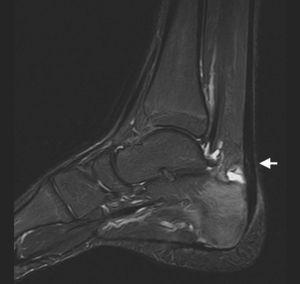 RM de tobillo, secuencia STIR (supresión grasa) en plano sagital. Se aprecia bursitis retroaquílea, engrosamiento del tendón de Aquiles con rotura parcial (flecha) y edema óseo en el calcáneo.