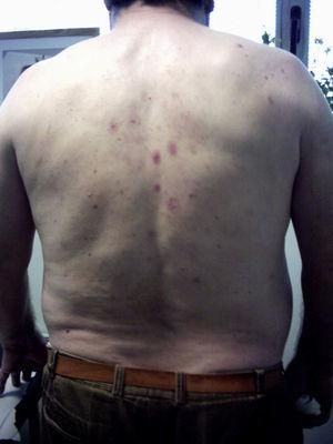 Lesiones eritemato-ampollosas en espalda.